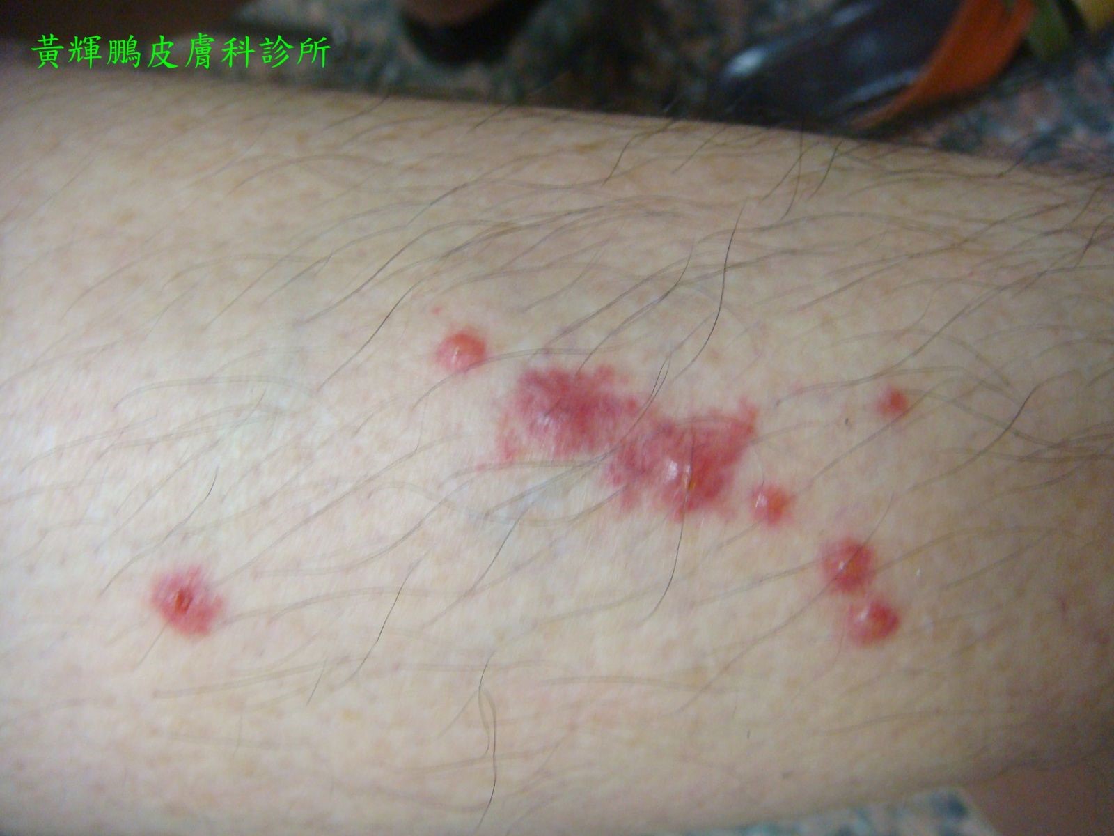 紅螞蟻咬傷 黃輝鵬皮膚科診所黃輝鵬皮膚科診所